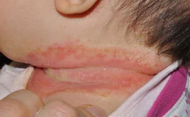 Dấu hiệu trẻ bị rôm sảy
