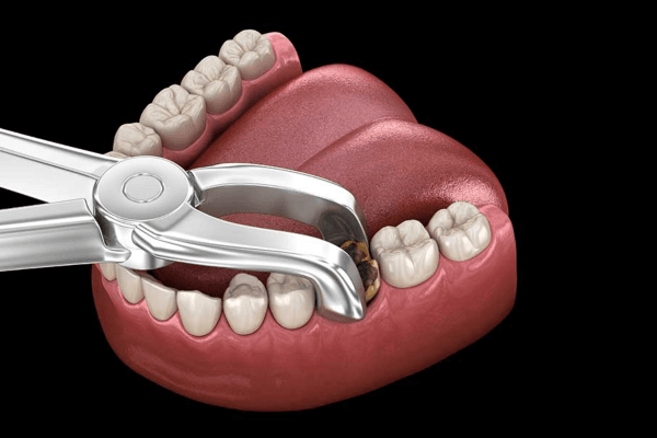 Phương pháp điều trị phụ thuộc vào nguyên nhân gây ra tình trạng đau nhức ở răng só 6