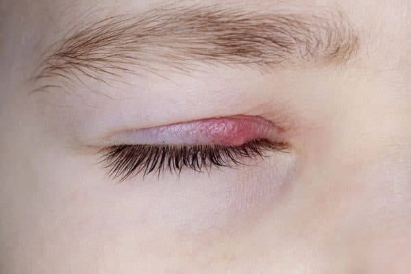 Viêm bờ mi là tình trạng viêm nhiễm ở bờ mi mắt do nhiều nguyên nhân gây ra