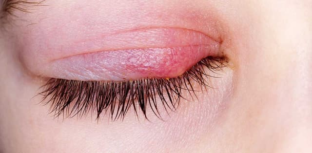 Nguyên tắc điều trị viêm bờ mi hiệu quả và an toàn