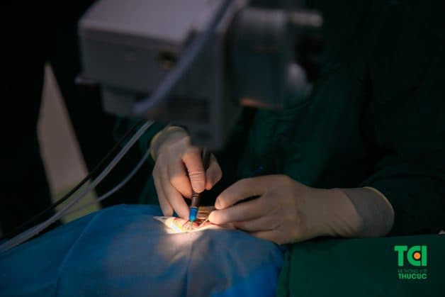 Điều trị viêm màng bồ đào để hạn chế suy giảm thị lực và mù lòa