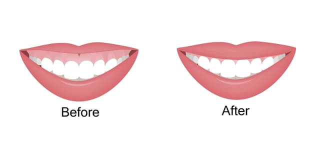 Giải pháp khắc phục cười hở lợi không phẫu thuật