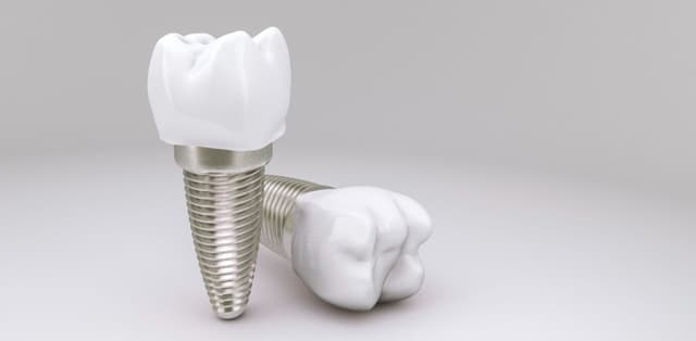 Giải đáp: Khi nào cần cấy implant cho răng?