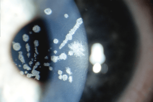 Loạn dưỡng màng đáy biểu mô xuất hiện những mảng xám tỏa lan (bản đồ), nang trắng (chấm), hoặc đường mảnh óng ánh (vân tay) ở trên biểu mô giác mạc