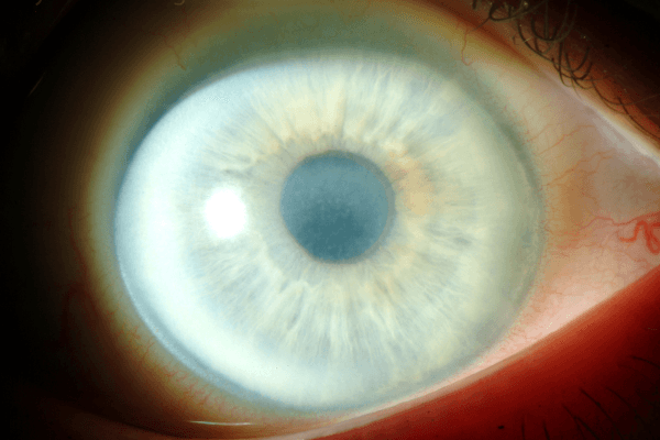 Loạn dưỡng Schnyder có những tinh thể nhỏ màu trắng vàng ở nhu mô trước, nằm tại giác mạc trung tâm