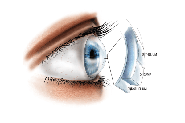 Loạn dưỡng giác mạc (Corneal Dystrophy) là tình trạng giác mạc bị lắng đọng một chất màu trắng đục