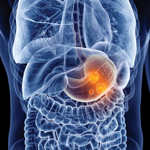 Biến chứng loét dạ dày có nguy hiểm không