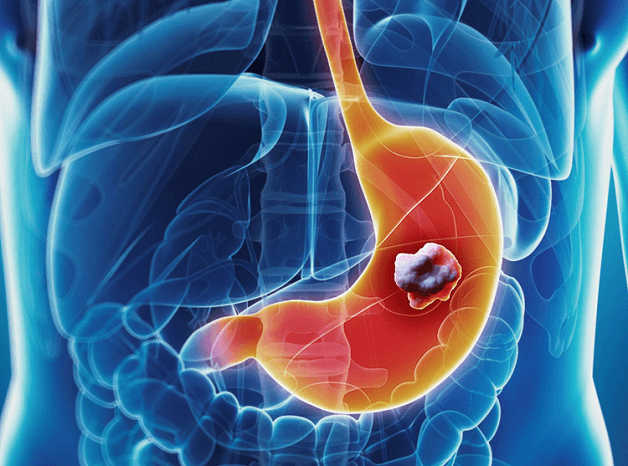 Ung thư là biến chứng vô cùng nguy hiểm