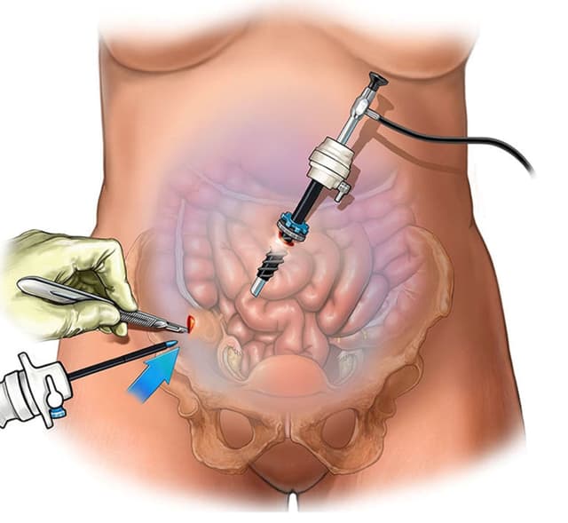Mổ chửa ngoài tử cung – Những thông tin người bệnh cần biết