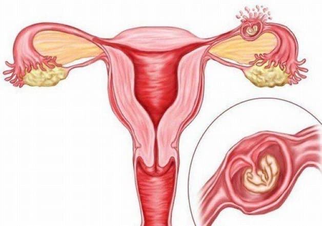 mổ chửa ngoài tử cung