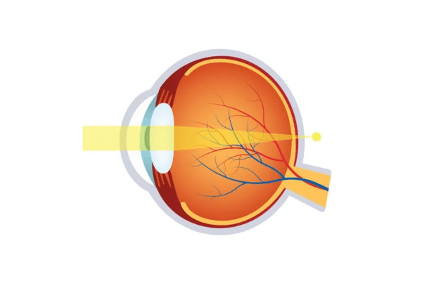 Viễn thị là tình trạng ánh sáng hội tụ sau giác mạc thay vì đúng trên giác mạc như mắt khỏe mạnh bình thường