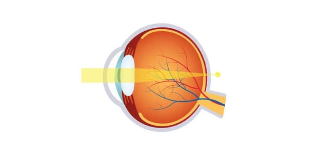 Nguyên nhân gây viễn thị và giải pháp khắc phục