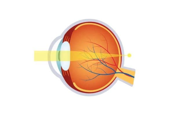 Viễn thị là tình trạng có thể nhìn được những vật ở xa nhưng gặp khó khăn khi nhìn vào những vật ở gần