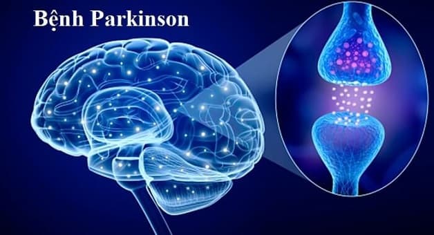 thông tin chung về bệnh Parkinson