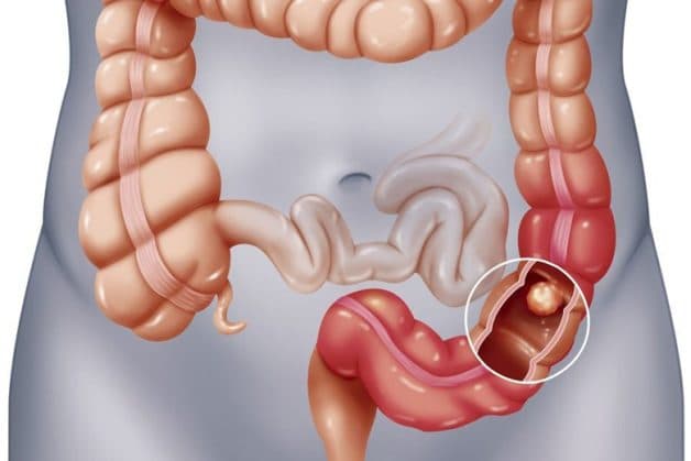 Polyp được bắt gặp nhiều nhất tại niêm mạc đại trực tràng