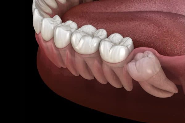 Lợi sưng đỏ, đau nhức ở xương hàm trong cùng là dấu hiệu cho thấy răng số 8 đang mọc