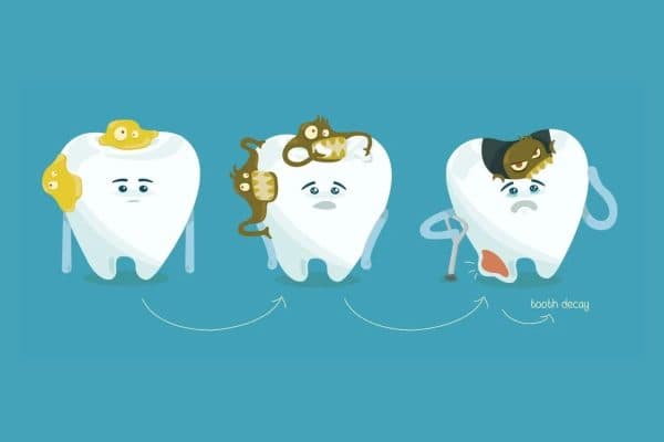 Nguyên nhân hàng đầu dẫn tới tình trạng sâu răng chính là sự tấn công của vi khuẩn