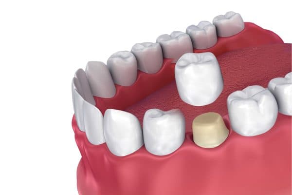 Điều trị răng số 6 bị sâu có thể áp dụng phương pháp bọc sứ, hàn trám...