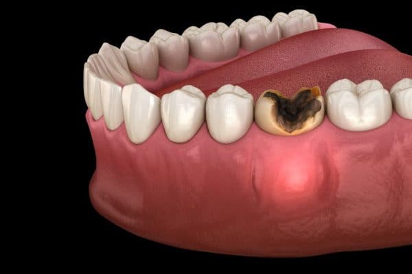 Sâu răng số 6 là tình trạng tổn thương mô cứng ở răng, gây ra các chấm, hốc đen trên bề mặt răng kèm theo các cơn đau nhức...