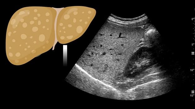 Hình ảnh siêu âm gan nhiễm mỡ