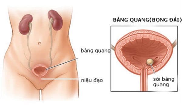 sỏi bàng quang gây ra nhiều biến chứng 