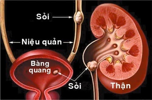 cách trị sỏi tiết niệu