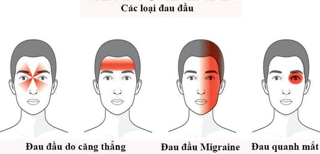 Tại sao đau đầu? Có phải đau đầu do căng thẳng?