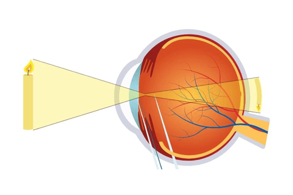 Mắt viễn thị có trục nhãn cầu ngắn hơn so với bình thường và hình ảnh, ánh sáng thu vào mắt nằm ở phía sau võng mạc