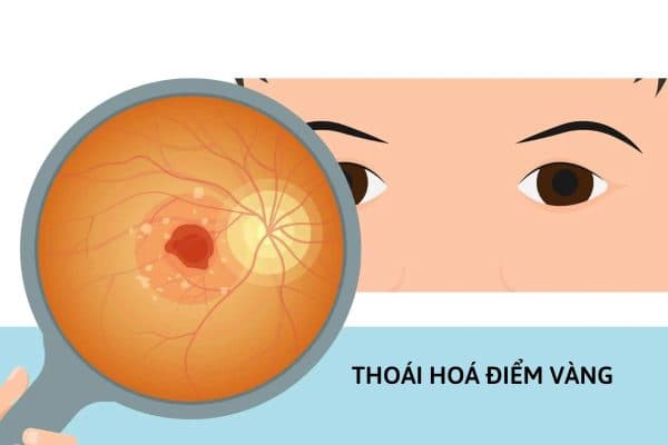 Thoái hoá điểm vàng là một trong những nguyên nhân hàng đầu dẫn tới suy giảm thị lực