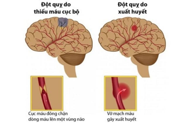 thiếu máu não gây đột quỵ