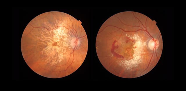 Hiểu đúng về thoái hóa điểm vàng ở mắt