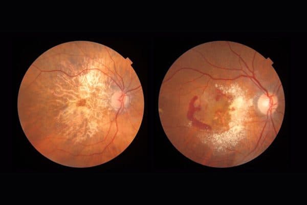 Thoái hóa điểm vàng ở mắt là tình trạng mất thị lực trung tâm do tổn thương hoàng điểm ở vùng trung tâm võng mạc