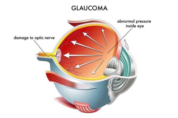 Thiên đầu thống xảy ra khi tình trạng áp lực trong mắt tăng quá cao, dẫn tới tổn thương thần kinh thị giác.