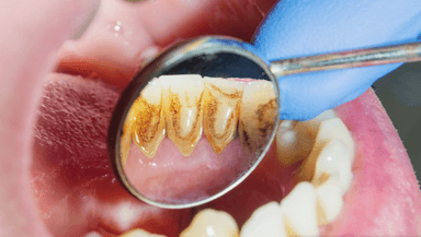 Lý do vì sao phải lấy cao răng định kì?