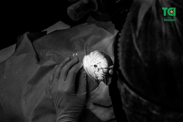 Viêm màng bồ đào trước: Nhận biết và điều trị