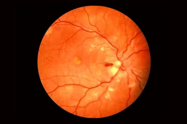 Bệnh võng mạc do tăng huyết áp thường gây ra những tổn thương ở võng mạc