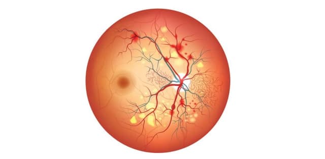 Tìm hiểu bệnh lý võng mạc tăng huyết áp