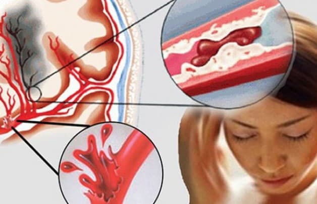Đột quỵ thể xuất huyết não 