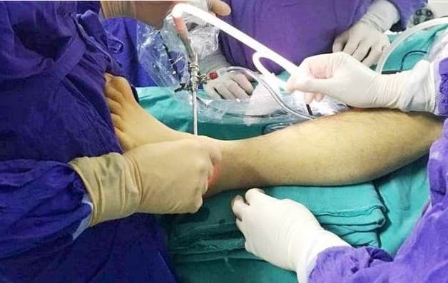 Phẫu thuật cho hội chứng ống cổ chân