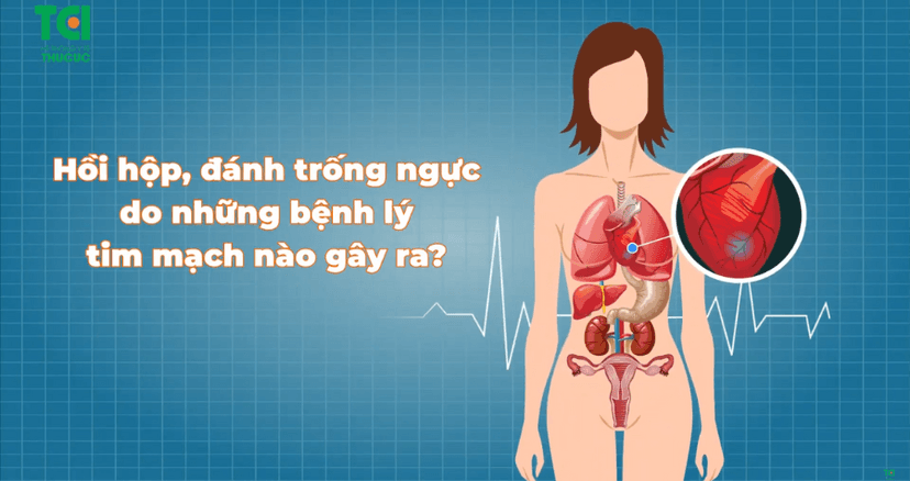 Hồi hộp đánh trống ngực: Tín hiệu cảnh báo nhiều bệnh lý tim mạch nguy hiểm