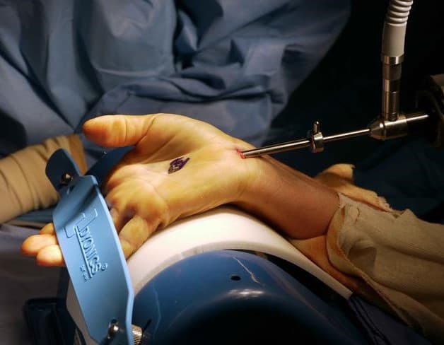 Phương pháp mổ nội soi hội chứng ống cổ tay