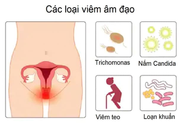 âm đạo nhiễm tạp khuẩn