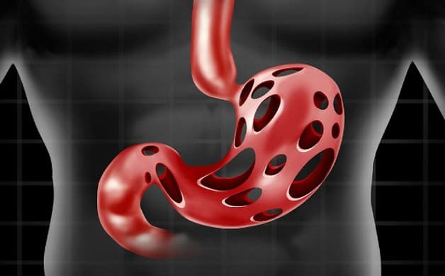 Bao tử bị loét là bệnh lý phổ biến ở hệ tiêu hóa 