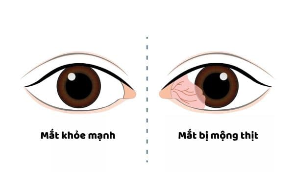 Mắt bị mộng thịt thường xuyên cộm đỏ, chảy nước mắt...