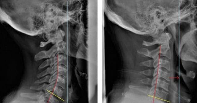 Vôi hóa đốt sống cổ: Nguyên nhân và cách điều trị hiệu quả