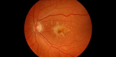 Tìm hiểu về bệnh thoái hóa hoàng điểm ở mắt