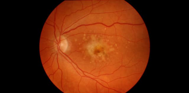 Tìm hiểu về bệnh thoái hóa hoàng điểm ở mắt