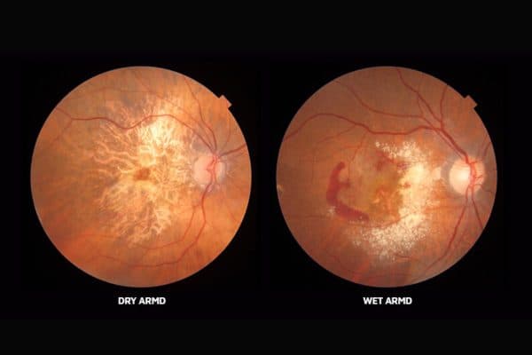 Thoái hóa hoàng điểm là tình trạng thương tổn hoàng điểm vùng trung tâm võng mạc