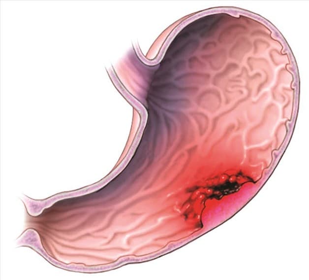 Bệnh viêm dạ dày và tá tràng là bệnh lý phổ biến ở hệ tiêu hóa
