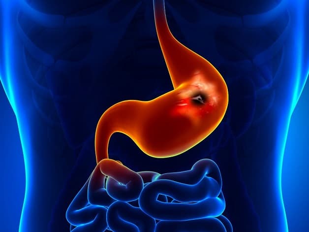 Loét dạ dày là bệnh lý phổ biến